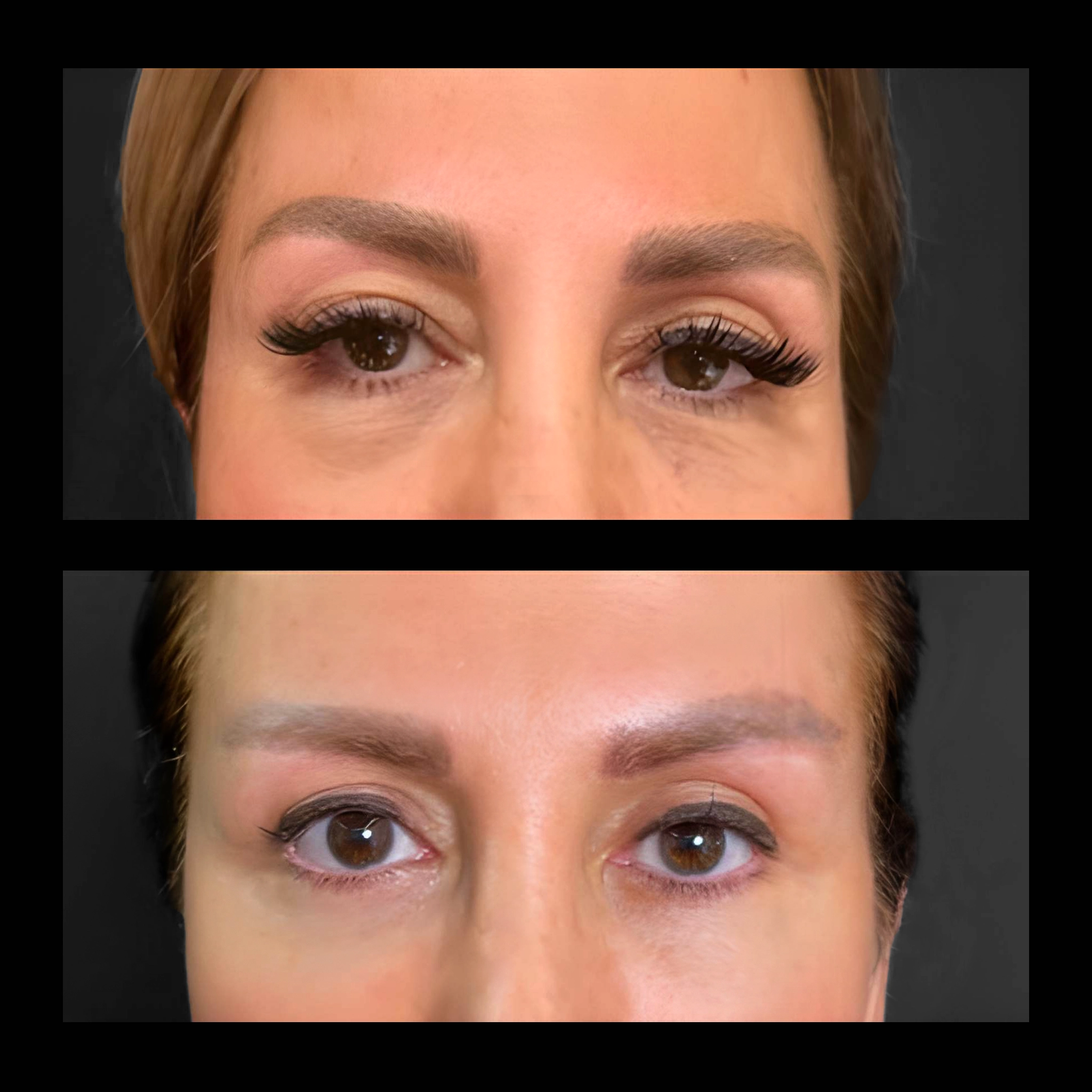 Belpharoplasty