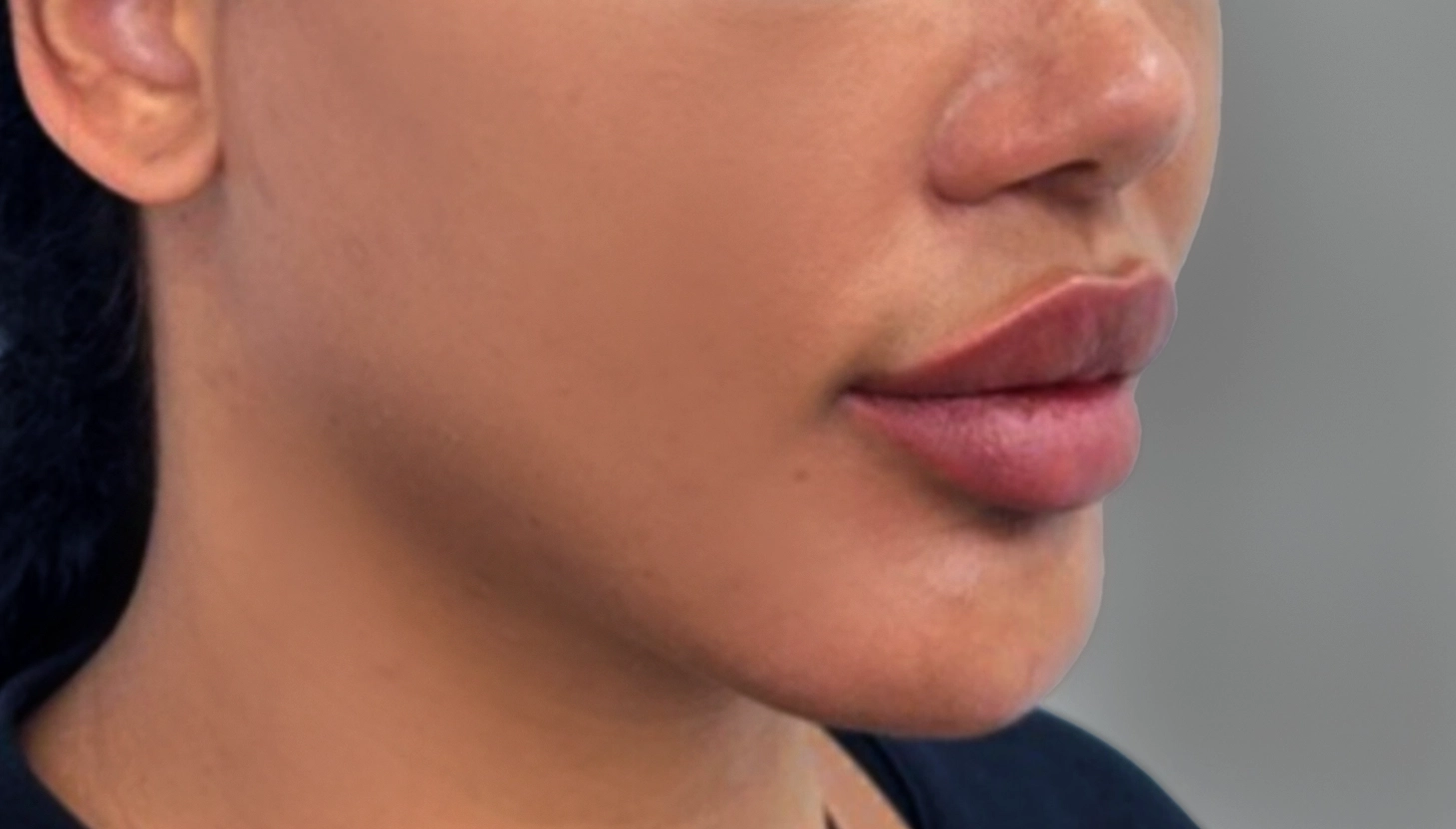 cheek augmentation